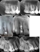 Klinička endodoncija 2: revizija...